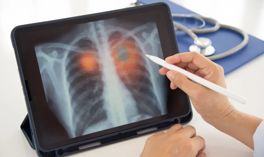 aspiración pulmonar